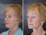 Facelift