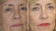 Laser Resurfacing
