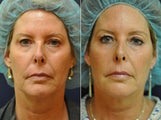 56 Year Old Female Before/After Ultherapy Full Face