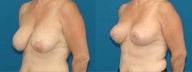 Breast lift (Mastopexy)