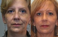 58 yo Midface filler and acne scarring