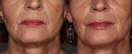 63 Year Old Female treated with Juvederm to her lips