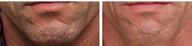 Fraxel Laser for Acne Scars
