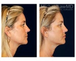 Liposuction