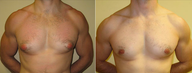 Male Breast Reduction