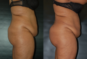 Brazilian Butt Lift