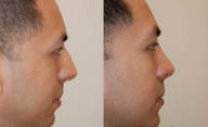 Rhinoplasty