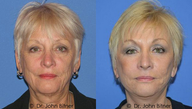 Brow Lift