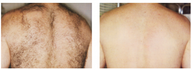 Laser Hair Removal