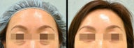 Lower Eyelid(Blepharoplasty) Surgery