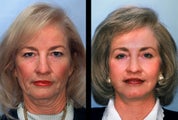 Female Radiesse Patient
