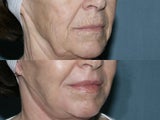 Face and Neck Fraxel repair with C02/Erbium lasers for upper lip wrinkles