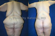 Body Lift 1