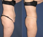 33 Year Old Female Treated with a Circumferential Bodylift (Fleur de Lis)