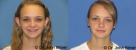 Otoplasty