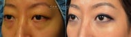 Before and After Bilateral Lower Blepharoplasty Surgery