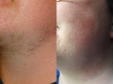 29 year old femal with excess facial hair presented for laser hair removal