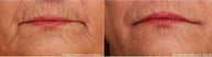 A woman in her 60s has smoker's lines treated with Belotero