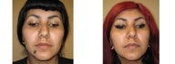 Mole Removal photos