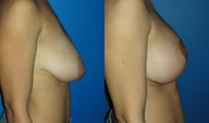 Breast Augmentation