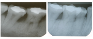 Bone Graft