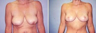 Breast Lift