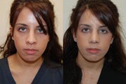 Rhinoplasty Surgery. 2 months post-op.