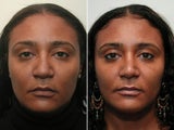 African American Rhinoplasty