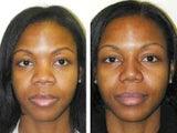African American Rhinoplasty