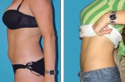 Liposuction Before & After