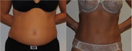 Liposuction Abdomen 40 Year old Female