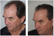 Facelift and hair transplant