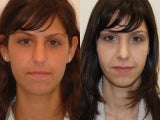 Rhinoplasty Surgery. 7-years post-op.