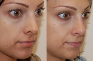Non Surgical Nose Job