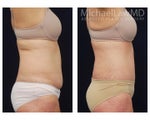 Liposuction