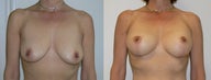 Breast Augmentation and Lift