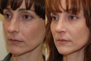 Rhinoplasty Surgery. 1 month post-op