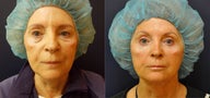 69 Year Old Female Before/After Ultherapy X2. 12 Months After (note, patient had a face lift 11 years earlier)
