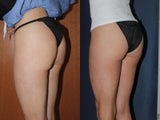 Before & After Ultherapy