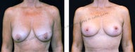 Breast Lift