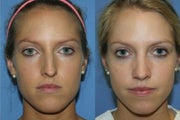 Rhinoplasty