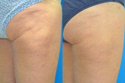 60 Year Old Female Treated for Cellulite