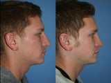 Rhinoplasty