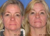 Brow Lift