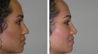 Ethnic Rhnioplasty Result