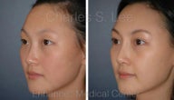 Blepharoplasty and Rhinoplasty