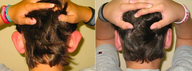 Ear Surgery