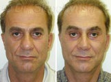 Facelift and Midfacelift
