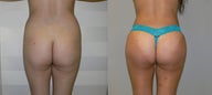 Brazilian Butt Lift - Liposuction love handles and lower back