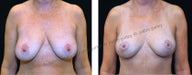Breast Lift